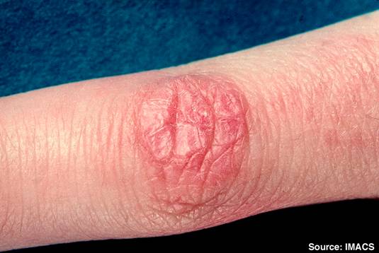 http://upload.wikimedia.org/wikipedia/commons/d/dd/Dermatomyositis3.jpg