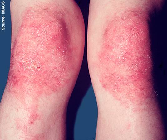 http://upload.wikimedia.org/wikipedia/commons/6/60/Dermatomyositis8.jpg