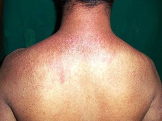 http://www.odermatol.com/wp-content/uploads/image/2013%202/5_Effect/fig_3j.jpg