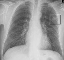http://upload.wikimedia.org/wikipedia/commons/thumb/b/bf/Thorax_pa_peripheres_Bronchialcarcinom_li_OF_markiert.jpg/220px-Thorax_pa_peripheres_Bronchialcarcinom_li_OF_markiert.jpg