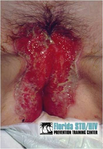 http://3.bp.blogspot.com/-BKjwKUbL-4M/UCZzcDPstFI/AAAAAAAAEDU/rPignvpWDFo/s1600/Genital+Herpes+Simplex.jpg