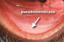 epidemic-keratoconjunctivitis2