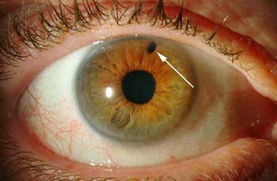 http://1.bp.blogspot.com/_QLeKhMxmr4M/TGGaBEzFrKI/AAAAAAAAANw/sppYoUWcmKA/s1600/peripheral+iridotomy.jpg