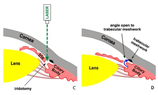 http://webeye.ophth.uiowa.edu/eyeforum/Images/glaucoma/9-4C-D.gif