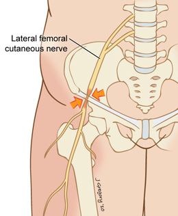 http://www.huidziekten.nl/afbeeldingen/illustraties/meralgia-paresthetica-1.jpg