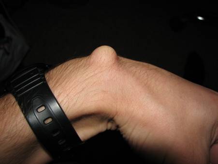 http://www.ehealthstar.com/wp-content/uploads/2013/09/Ganglion-Cyst.jpg