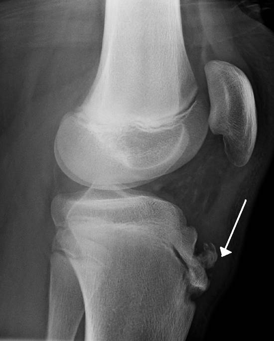 http://upload.wikimedia.org/wikipedia/commons/5/51/Radiograph_of_human_knee_with_Osgood%E2%80%93Schlatter_disease.png