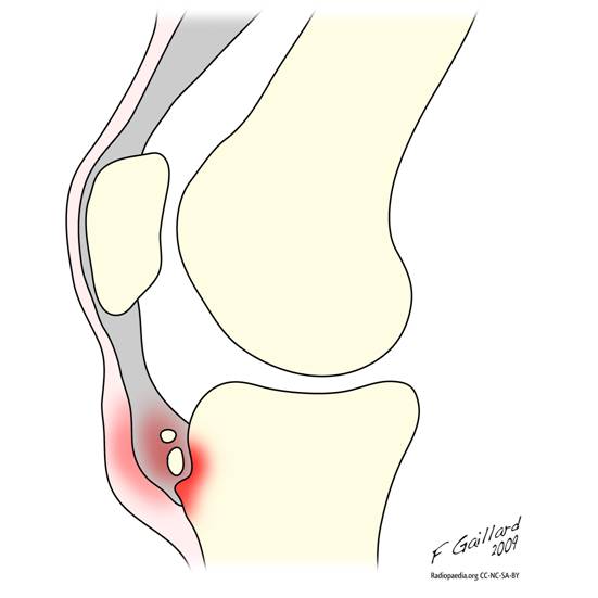 http://images.radiopaedia.org/images/133811/baa24b74bdcadee1185a894f77a675.png