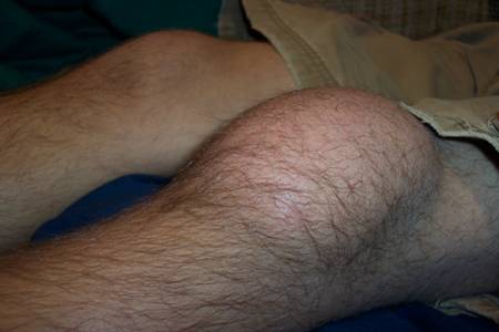 http://upload.wikimedia.org/wikipedia/commons/e/e8/Prepatellar_bursitis.JPG
