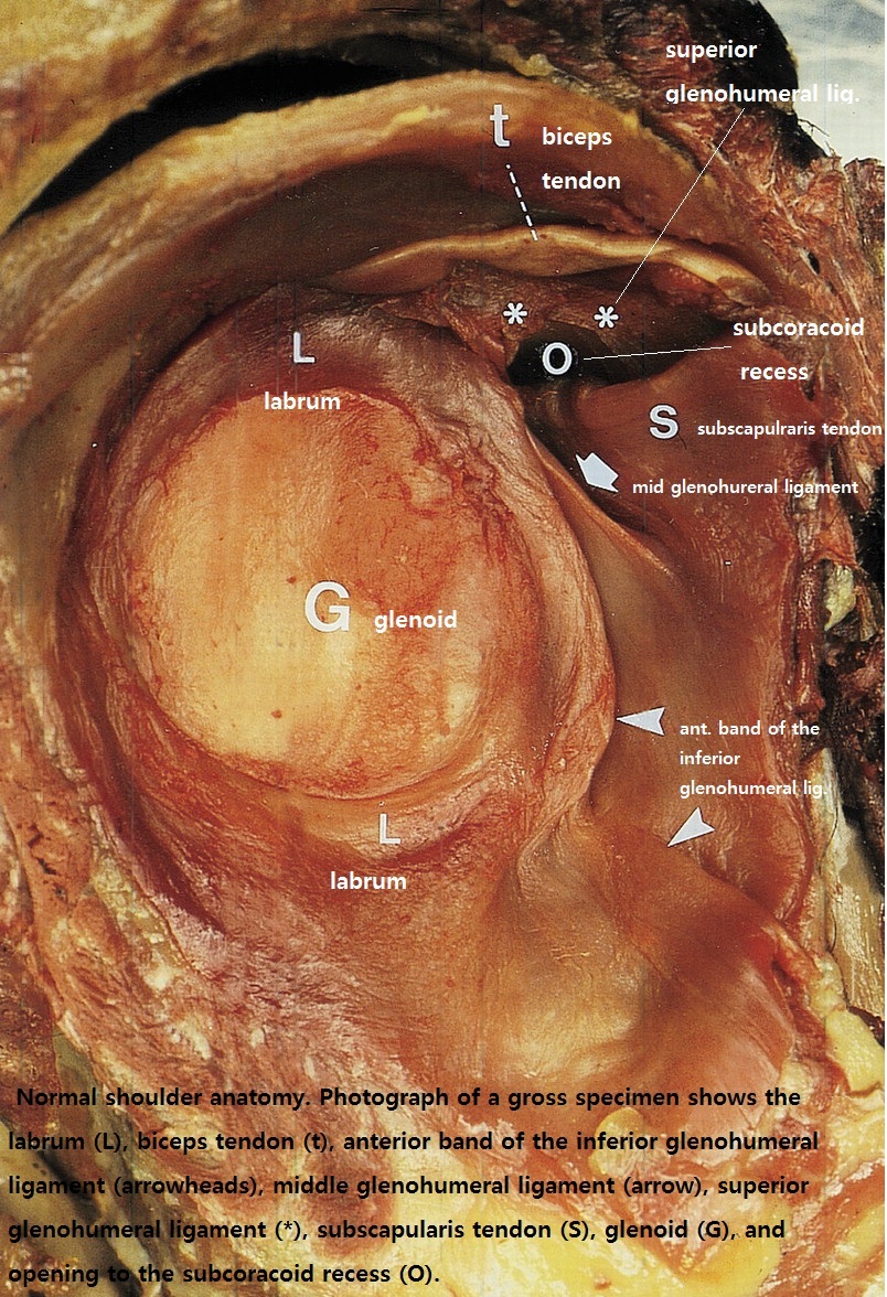 http://radiographics.rsna.org/content/20/suppl_1/S67/F2.large.jpg