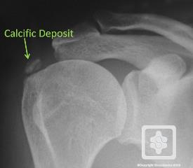 http://www.shoulderdoc.co.uk/images/uploaded/sdoc_calcific_tendonitis_xr.jpg