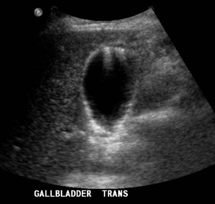 http://images.radiopaedia.org/images/4645/583684bc77a70874bd3dd4867dfe1a_gallery.jpg