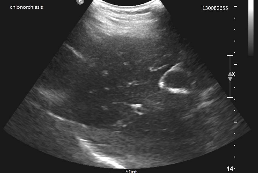 chlonorchiasis.jpg