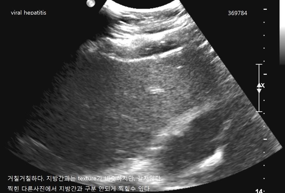 viral hepatitis.jpg