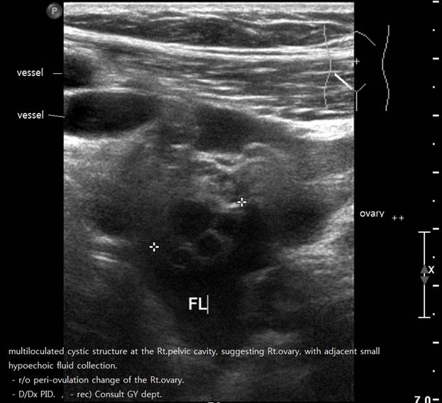 ovary.jpg