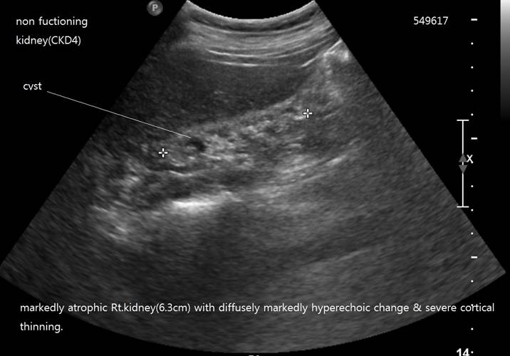 nonfuctioningkidney.jpg