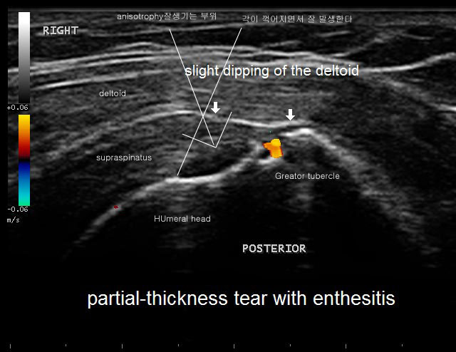 partial-tear-enthesopathy-s.jpg