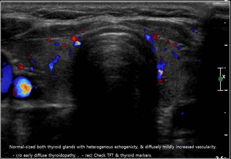 nodule1.jpg