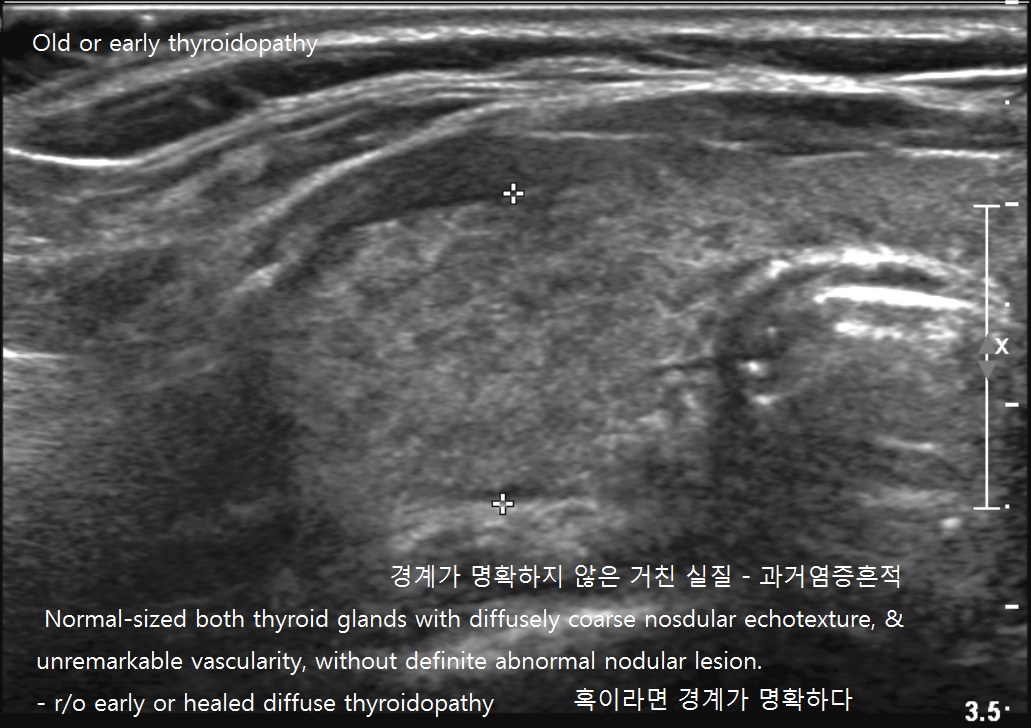 diffusethyroidopathy.jpg