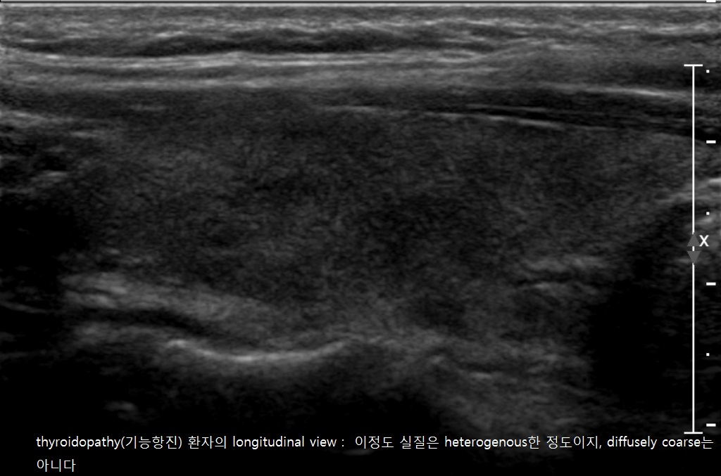 nodule12.jpg