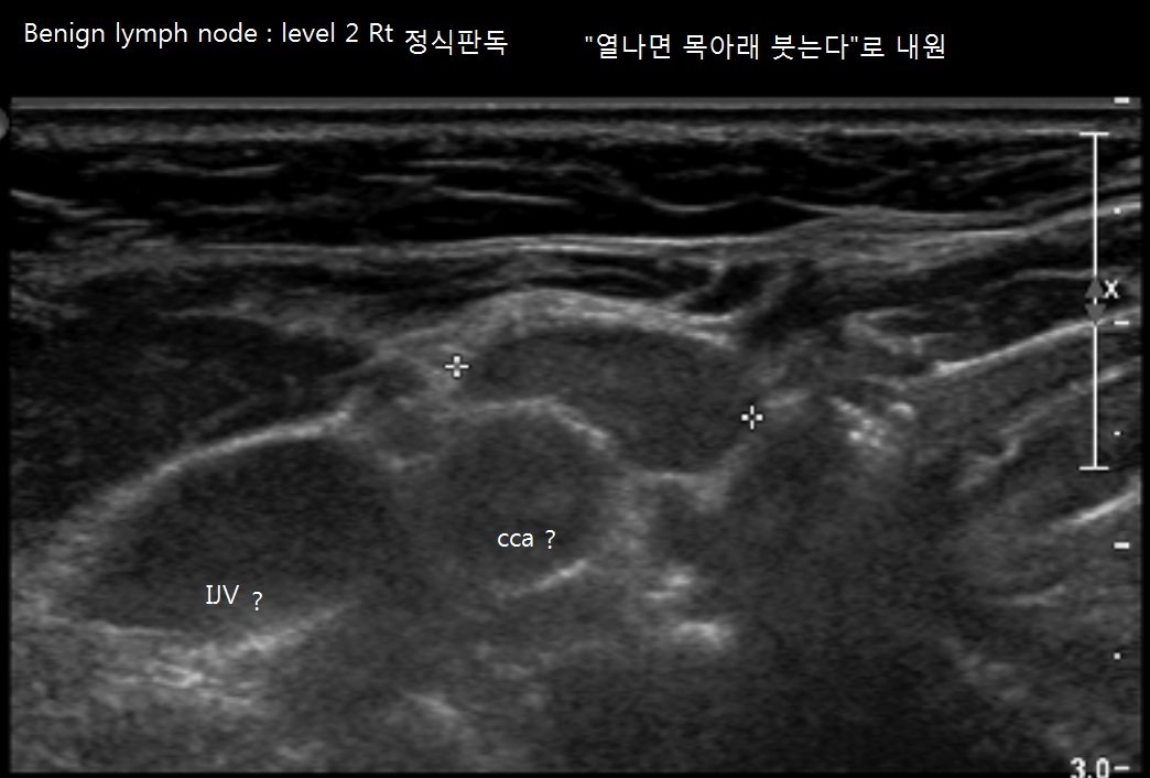 benign node.jpg