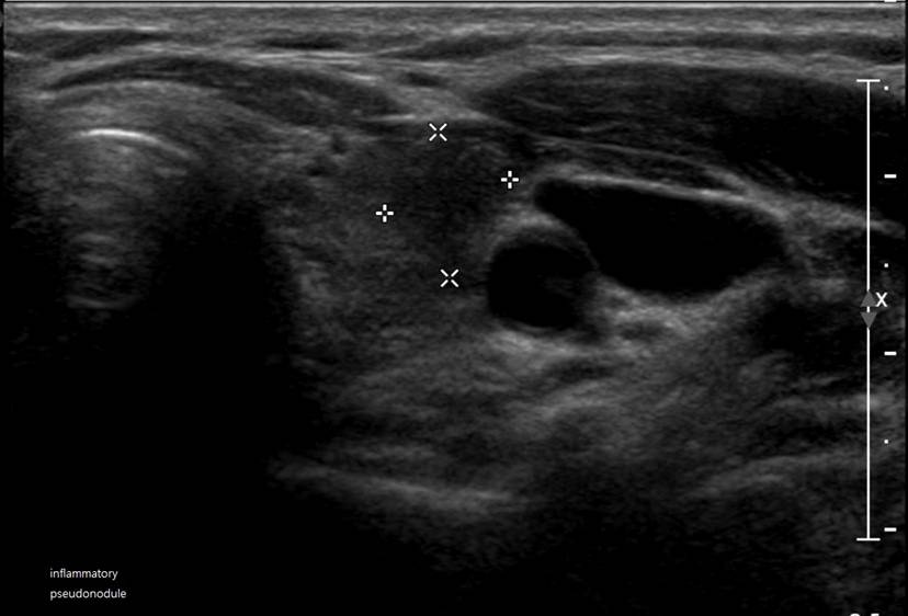 nodule.jpg
