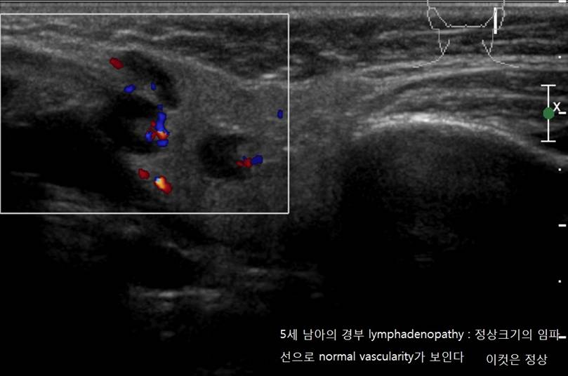 lymphadenopathy.jpg