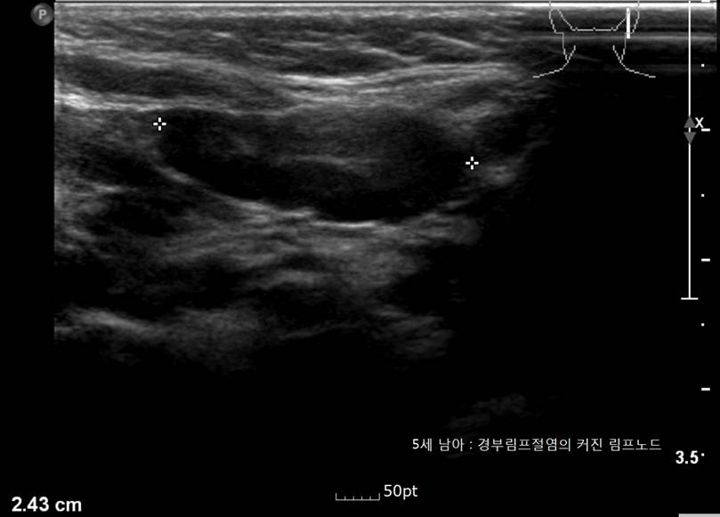 lymphadenopathy1.jpg