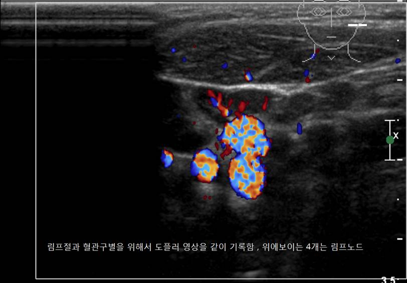 lymphadenopathy2.bmp