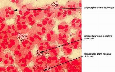 http://www.medicalook.com/diseases_images/gonorrhea.jpg
