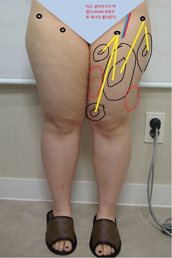 thigh2.jpg