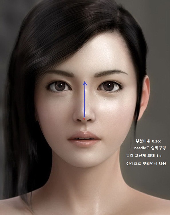 nose filler.jpg