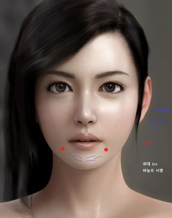 chin filler.jpg