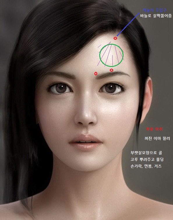 forehead filler.jpg